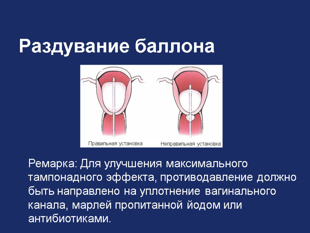 Раздувание баллона Ремарка: Для улучшения максимального тампонадного эффекта, противодавление должно быть направлено на уплотнение